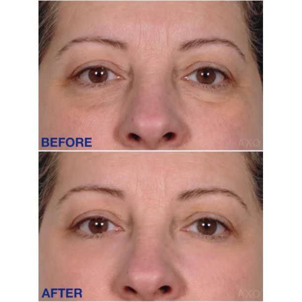 Age-Defying Under-Eye Serum | Best Instant Wrinkle Remover | Advanced Formula Anti Aging Visibly Reduces Under Eye Wrinkles, Bags, Dark Circles, Fine Lines & Crow’s Feet | 100% All-Natural-BrightBean Baby