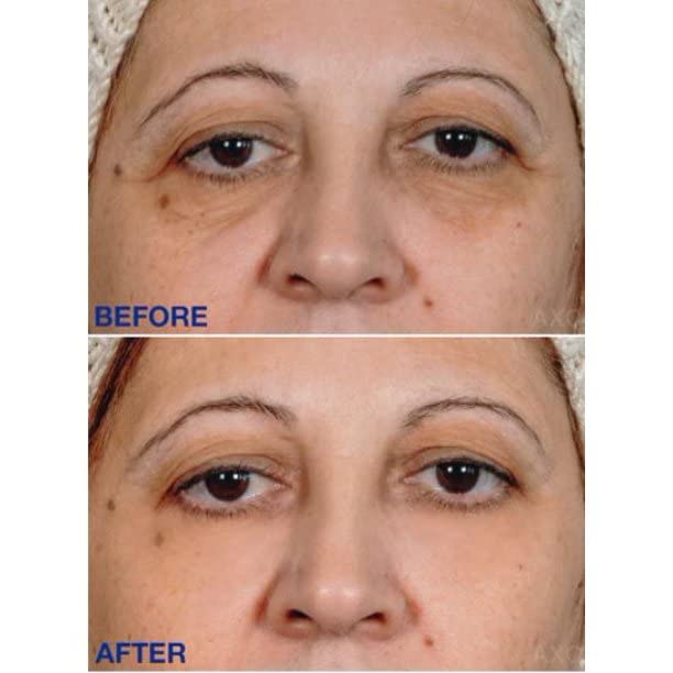 Age-Defying Under-Eye Serum | Best Instant Wrinkle Remover | Advanced Formula Anti Aging Visibly Reduces Under Eye Wrinkles, Bags, Dark Circles, Fine Lines & Crow’s Feet | 100% All-Natural-BrightBean Baby
