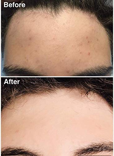 Teenology Shampoo for Teens - Avoid Forehead and Body Acne - No Sulfates or Parabens, Noncomedogenic, Natural Botanical Extracts, 16 oz. (Sweet Mint)-BrightBean Baby