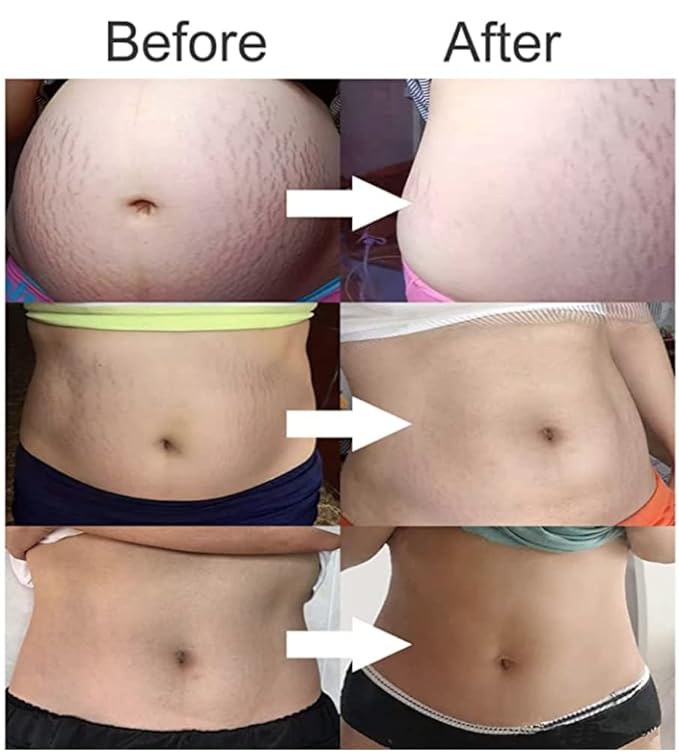 Stretch Mark Cream 120g/4 oz Stretch Marks Lotion Pregnancy Creams, Belly Butter Pregnant Women Stretch Mark Removal Treatment, Maternity Skin Care Moisturizer Scar Wrinkle Prevention-BrightBean Baby
