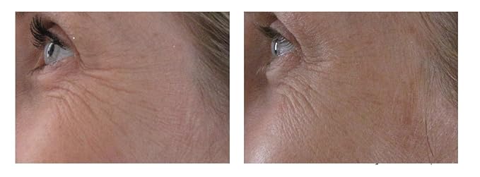 Airelle Age-Defying Eye and Lip Treatment | Anti Aging, Helps Reduce Wrinkles, Fine Lines | Dermatologist Recommended | Hyaluronic Acid, Berrimatrix | Natural Ingredients | .3 Fl Oz-BrightBean Baby