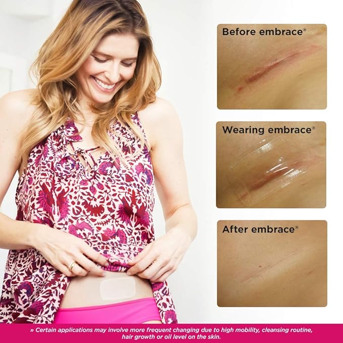 Embrace Active Scar Defense for New Scars, FDA-Cleared Silicone Scar Sheets, 2.4 Inch, Medium, 60 Day Supply (Recommended Treatment)-BrightBean Baby