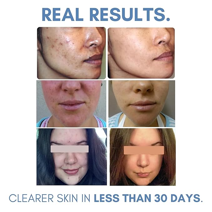 Clarifying Toner for Acne and Blemishes, Face Toner, Facial Toner, Skin Toner, Acne Toner, Toner Oily Skin, Salicylic Acid Toner, Astringent for Face, Toners, 4 Fl Oz-BrightBean Baby