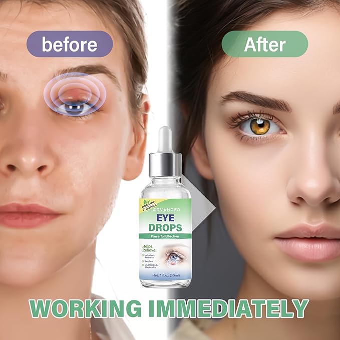 Stye Eye Treatment, Stye Eye Drops Serum for Styes Chalazion and Blepharitis, Chalazion Remover Fast Relief, Restore Healthier Eye Skin, 30ml-BrightBean Baby