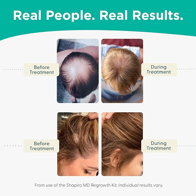 Shapiro MD Hair Growth Experts Hair Loss Shampoo and Conditioner, DHT Fighting Vegan Formula for Thinning Hair Developed by Dermatologists, Experience Healthier, Fuller Thicker Hair, 4 Month Supply-BrightBean Baby