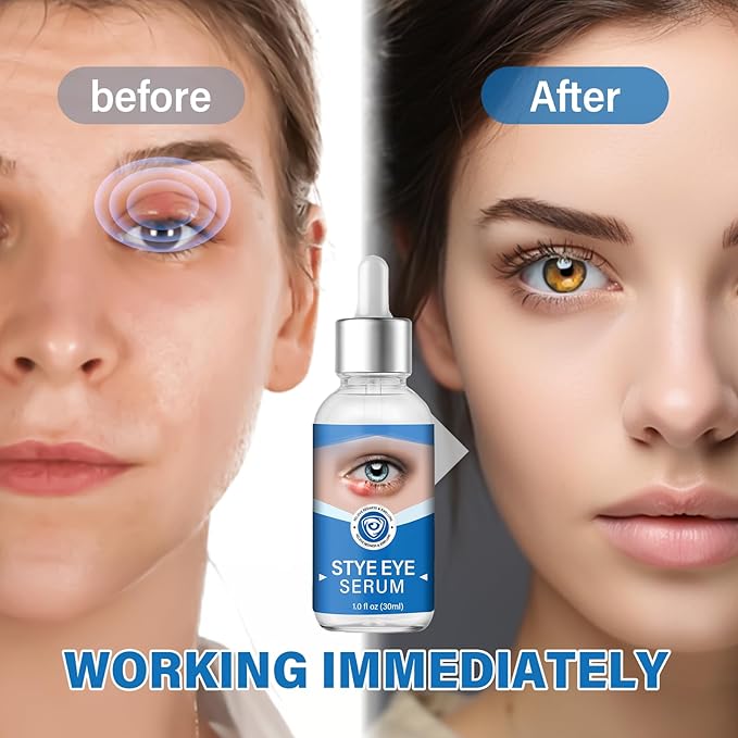 Stye Eye Treatment, Stye Eye Serum for Styes Chalazion and Blepharitis, Gently Cleanses Lashes and Eyes, Restore Healthier Eye Skin, 1 Fl.oz-BrightBean Baby