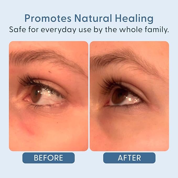 twenty/twenty Easy On The Eyes – 0.02% Hypochlorous Acid Spray to Cleanse Eyelashes – Reduce Eyelid Irritation – Safe for Sensitive Skin – Ophthalmologist Developed–Vegan, Clean Ingredients – 60ml-BrightBean Baby