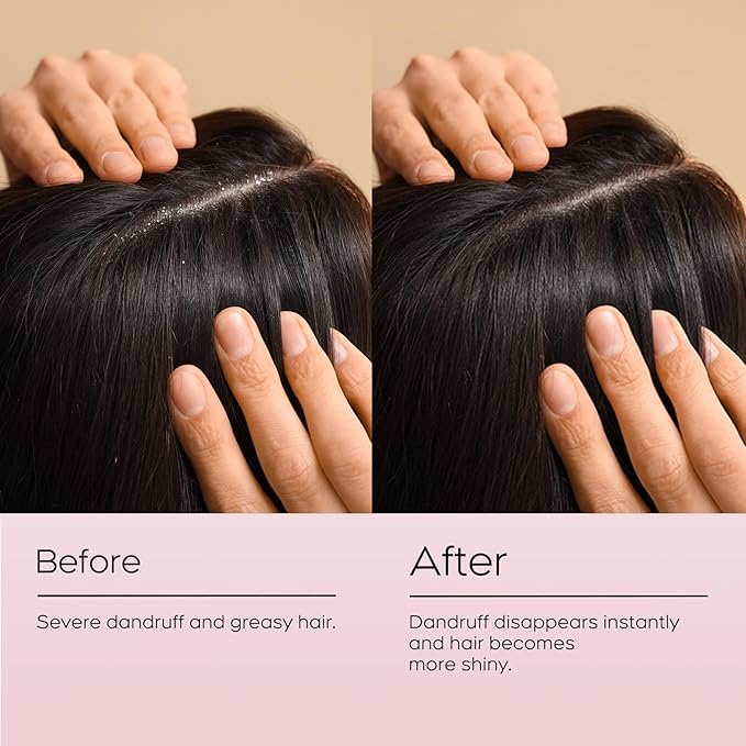 24HR Fast Itch Relief Anti-Fungal Shampoo for Psoriasis, Seborrheic Dermatitis & Folliculitis, Relieves Itchy, Dry Scalp, Sulfate & Paraben Free Anti-Dandruff Shampoo for Men and Women, 8.4 fl oz-BrightBean Baby