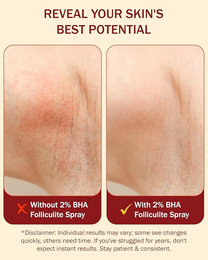2% BHA Folliculitis Body Oil Spray - Salicylic Acid Body Mist with Tea Tree Oil & Aloe Vera - Spray Moisturizer for Dry Skin, Clogged Pores & Irritation, 4 fl. oz-BrightBean Baby