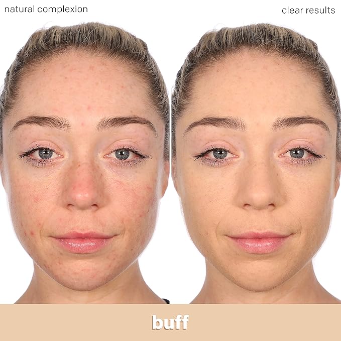 Almay Clear Complexion Acne Foundation Makeup with Salicylic Acid - Lightweight, Medium Coverage, Hypoallergenic, -Fragrance Free, for Sensitive Skin , 200 Buff, 1 fl oz.-BrightBean Baby