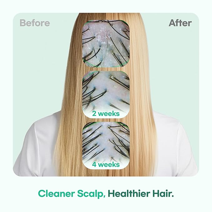 TS GD Shampoo for Teens | Korean Anti-Dandruff Shampoo for Oily & Itchy Scalp | Fruity Allergy-Free Scent | Sulfate-Free Gentle Hair Care (14.1 Oz)-BrightBean Baby