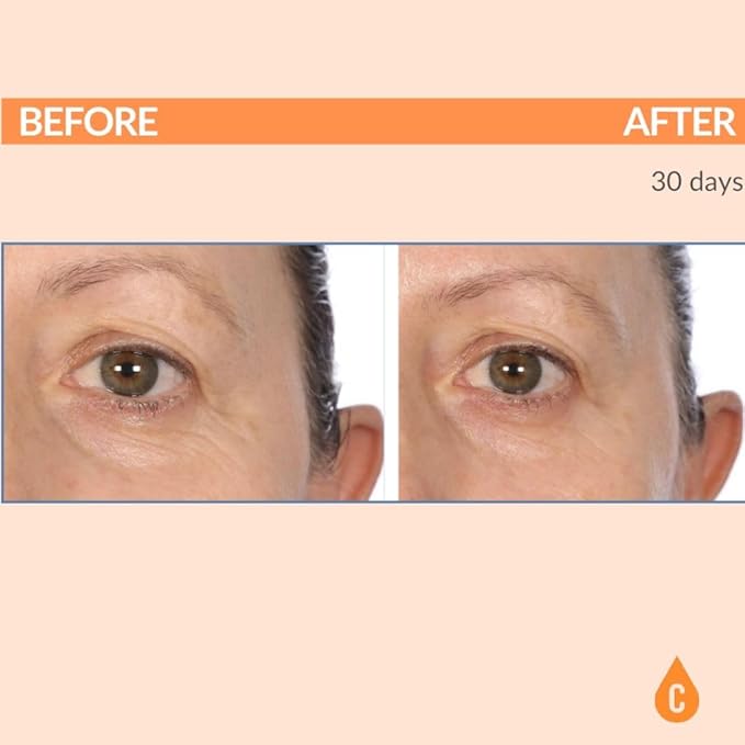 Serious Skincare - C3 Vitamin C Ester Eye Beauty Treatment with Hyaluronic Acid - For Dull & Dry Under Eyes - Soothing C3 Plasma Gel Formula for Fine Lines, Wrinkles, Discoloration - 0.5 oz.-BrightBean Baby