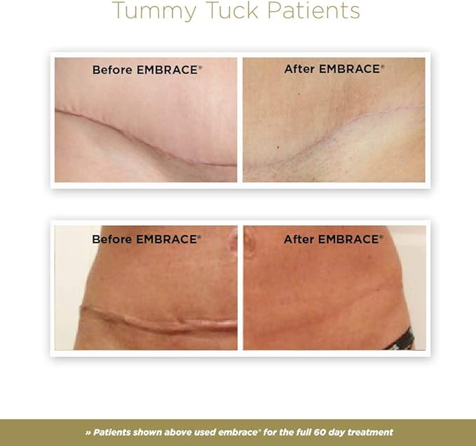 Embrace Active Scar Defense for New Tummy Tuck Scars, FDA-Cleared Extra-Large Silicone Scar Sheets, 30 Day Supply-BrightBean Baby