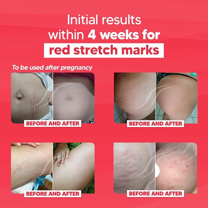 Cicatrissim Red For Removal of Red and Purple Stretch Marks - Innovative Formula With Pure and Powerful Natural Ingredients From Brazilian Flora - For All Skin Types.-BrightBean Baby