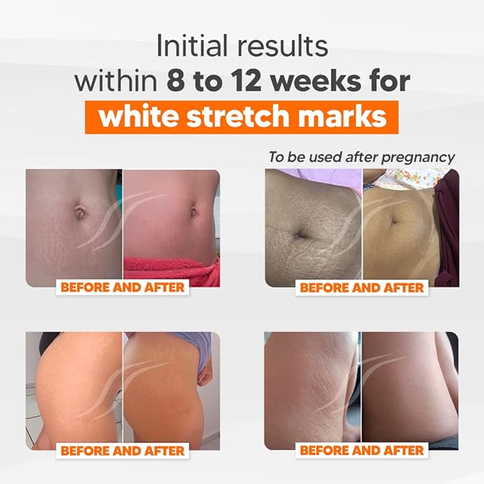 Cicatrissim Deep Stretch Mark Removal Cream - Innovative Formula With Pure and Powerful Natural Ingredients From Brazilian Flora - For All Stretch Marks & Skin Types.-BrightBean Baby