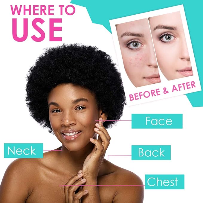 Bye Bye Blemish Acne Drying Lotion, Reduce Pimples Overnight, On-the-Spot Pimple Treatment, Beauty Skincare Essential - 1oz. (3 Pack)-BrightBean Baby