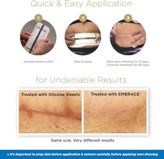 Embrace Active Scar Defense for New Scars, FDA-Cleared Medical-Grade Silicone Scar Sheets for Hypertrophic & Keloid Scar Treatment, 4.7 Inch, Large, 30-Day Supply-BrightBean Baby