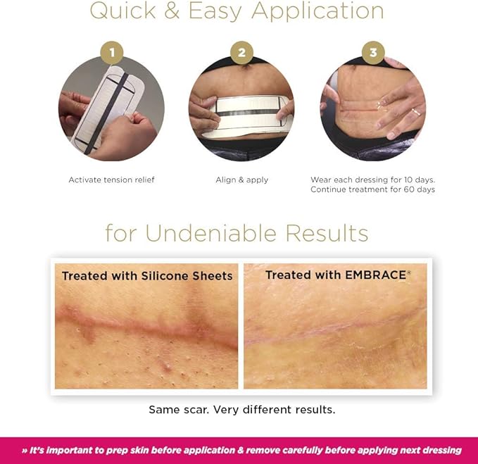 Embrace Active Scar Defense for New Scars, FDA-Cleared Silicone Scar Sheets, 2.4 Inch, Medium, 60 Day Supply (Recommended Treatment)-BrightBean Baby