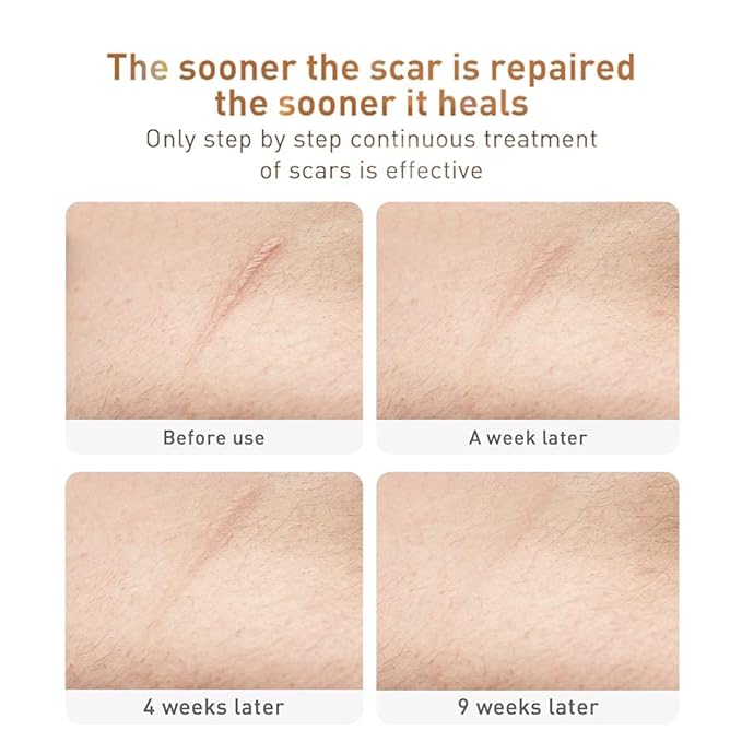 Acne Scar Removal Cream Stretch Marks Face Skin Cream Shrink Pores Gel-Fade Scar Marks Acne Skin Care (Packaging Upgrade) VeniCare-BrightBean Baby