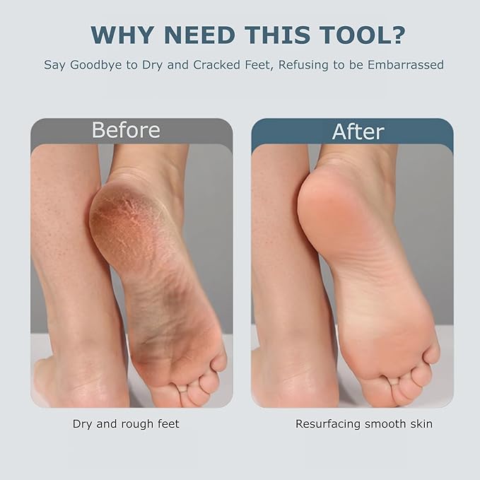 Upgraded Electric Foot Callues Remover, Portable Electric Foot Files with 3 Heads, Rechargeable Feet File for Foot Care, Waterproof Deadskin Remover, Pedicure Tool for Dry and Crack Feet-BrightBean Baby