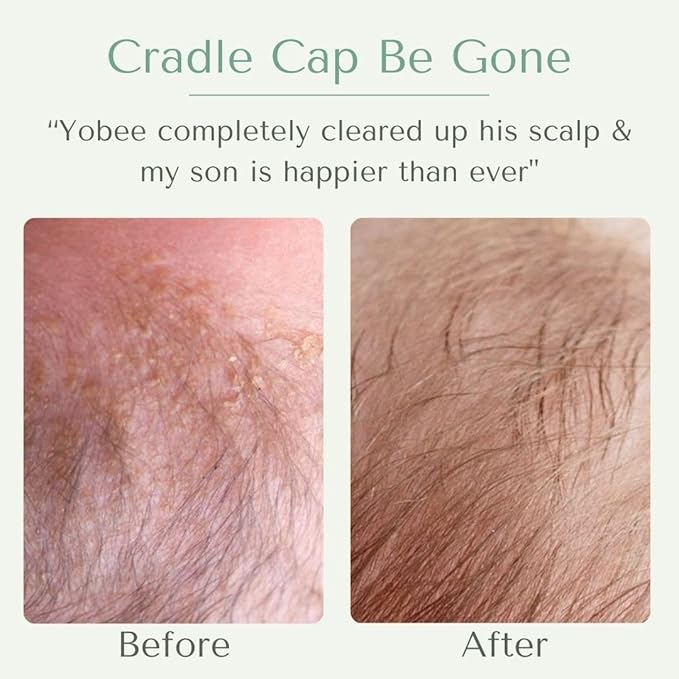 Yobee Ultra Gentle Soothing Scalp Mask - Dry Scalp Treatment Hair Mask Safe For Sensitive Baby Skin - Probiotic Infused - For Sensitive Scalp & Cradle Cap - For Babies, 4 fl oz-BrightBean Baby