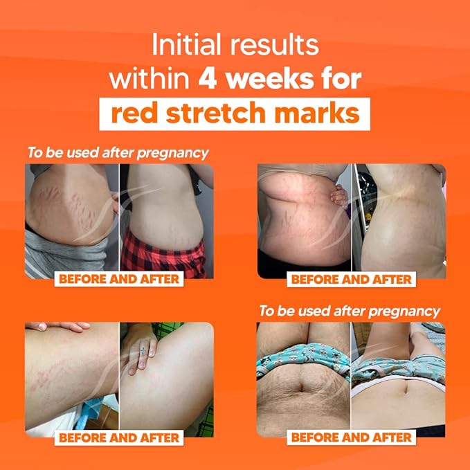 Cicatrissim Deep Stretch Mark Removal Cream - Innovative Formula With Pure and Powerful Natural Ingredients From Brazilian Flora - For All Stretch Marks & Skin Types.-BrightBean Baby