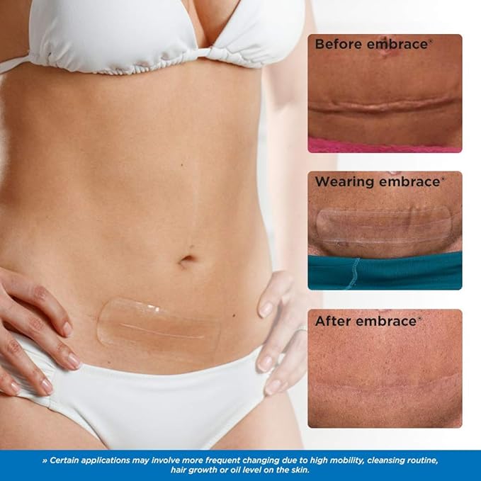 Embrace Active Scar Defense for New Scars, FDA-Cleared Medical-Grade Silicone Scar Sheets for Hypertrophic & Keloid Scar Treatment, 4.7 Inch, Large, 30-Day Supply-BrightBean Baby