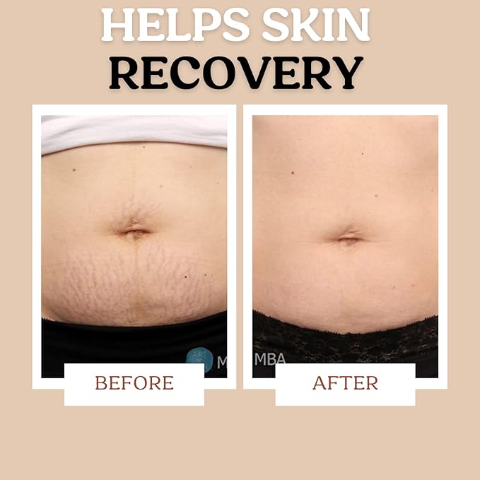 Stretch Mark Cream for Sensitive Skin Plant-Based Long and Short-term Hydration, Increases Skin Elasticity and Firmness (Stretch Mark Cream)-BrightBean Baby