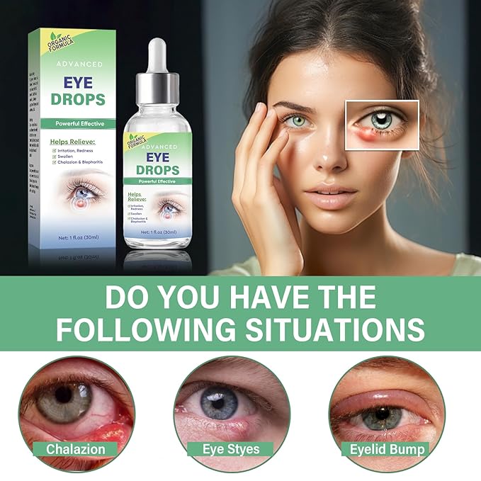 Stye Eye Treatment, Stye Eye Drops Serum for Styes Chalazion and Blepharitis, Chalazion Remover Fast Relief, Restore Healthier Eye Skin, 30ml-BrightBean Baby