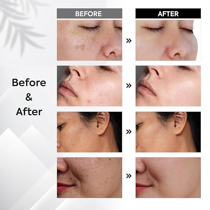 Dark Spot Remover for Face: Remove Sun & Age Spot Corrector – Melasma & Hyperpigmentation Brightening Serum for Body(Hand Leg Arm) – Brown Skin and Freckles Removal Treatment with Roller 15ml-BrightBean Baby