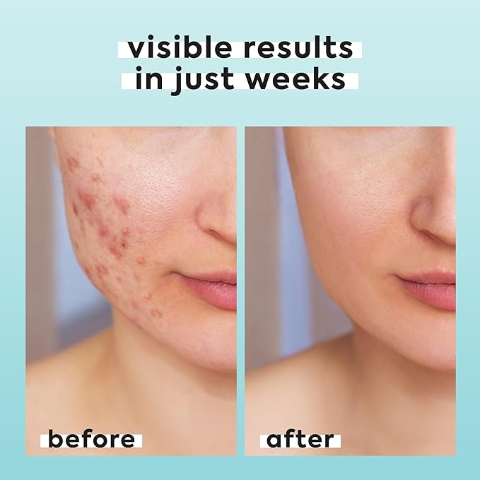 Hypochlorous Acid Spray for Face & Body - Helps Reduce Redness and Breakouts - Travel Size Hypochlorous Spray, Multi-Purpose Topical Facial Skin Repair, pH-Balancing Toner - TSA, Livaclean-BrightBean Baby
