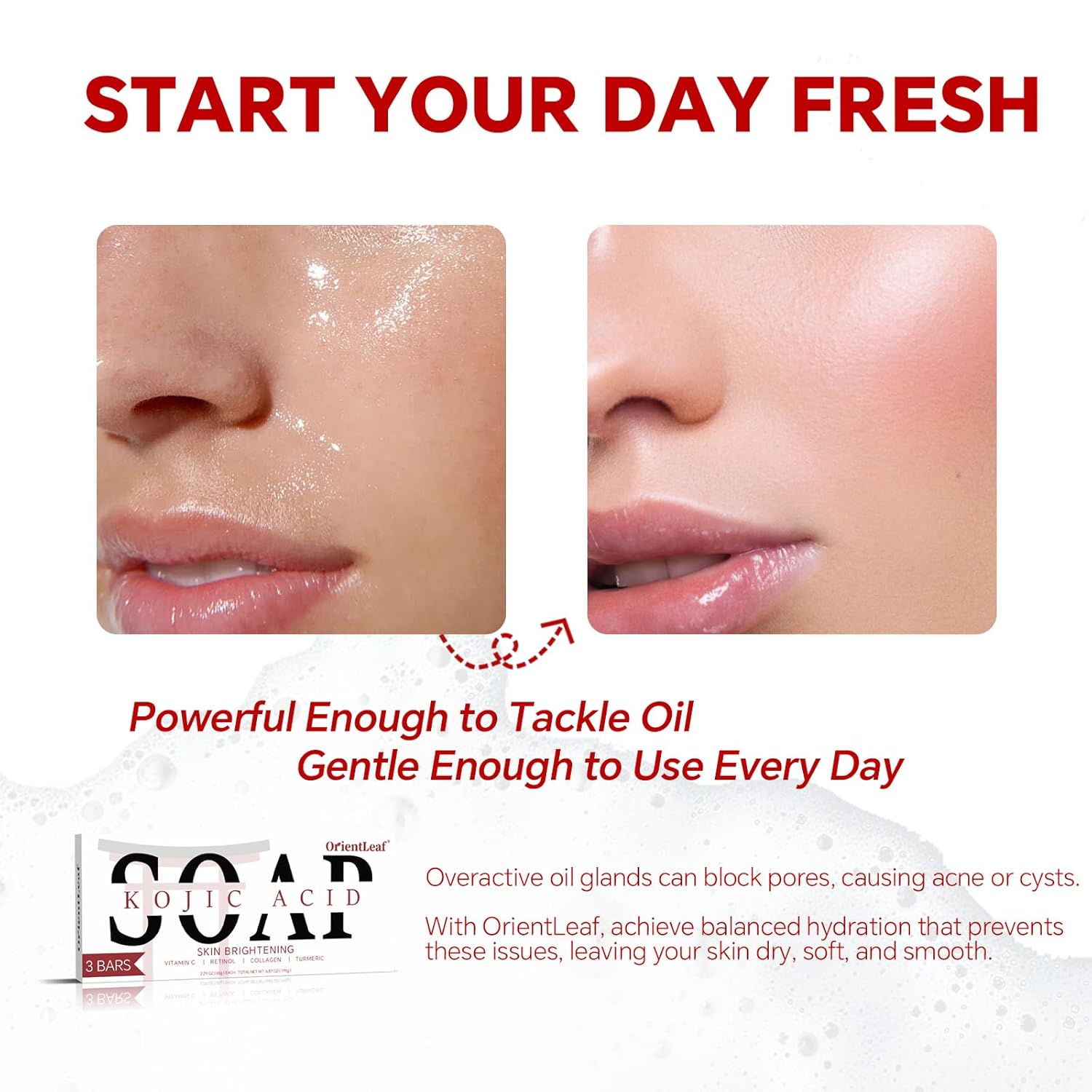 Kojic Acid Soap, Turmeric Soap Bar for Dark Spots, Fresh Citurs Scent, Gentle for Face and Body Wash with Vitamin C, Shea Butter, Retinol, Olive Oil, Collagen (3 PACK)-BrightBean Baby