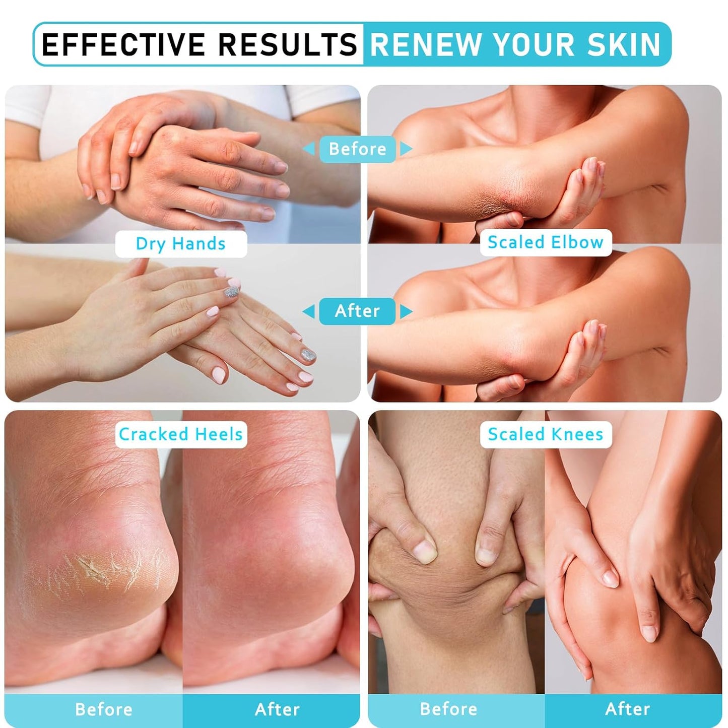 Urea Cream 40 Percent For Feet Maximum Strength - plus Salicylic Acid 2% Foot Cream For Dry Cracked Heels Feet Knees - Dead Skin Cuticle Callus Remover Toenail Softener-BrightBean Baby