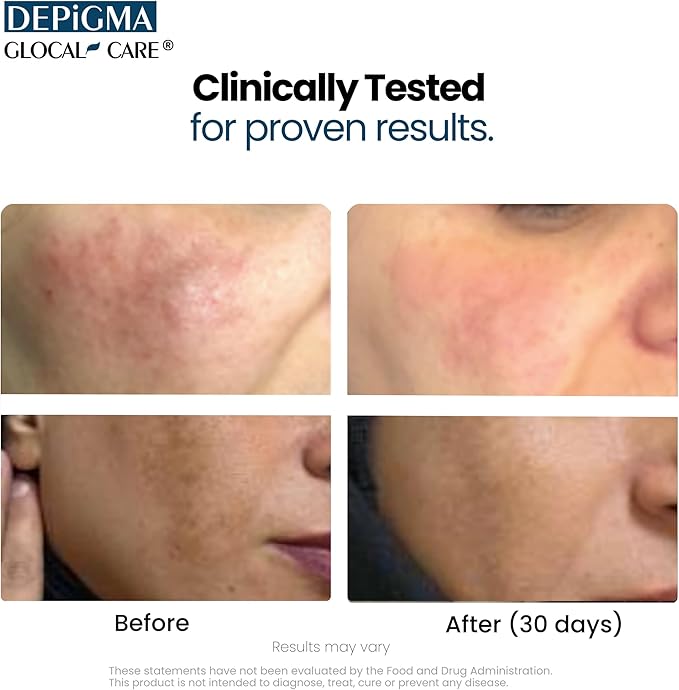 GlocalCare Depigma Support Reduction of Hyperpigmentation, Melasma & Dark Spots with Glutathione, Polypodium Leucotomos, Grape Seed & Marigold Extract-BrightBean Baby