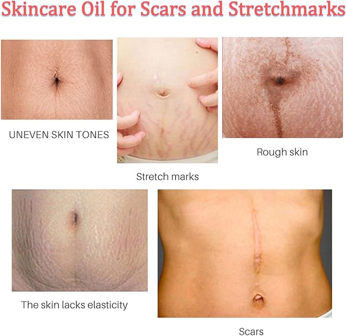 Stretch Mark Pregnancy Massage Oil, Stretch Mark Oil, Skincare Oil for Improve Stretchmarks, Pregnancy Skin Care Fade Stretch Marks, Body Moisturizer for Dry Skin, First Time Mom Gift 30 ml-BrightBean Baby