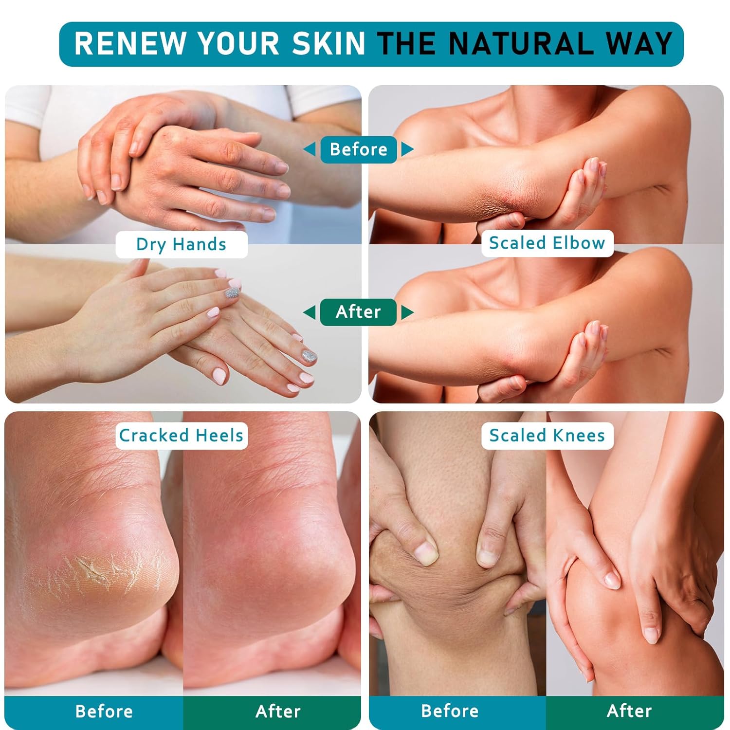 Urea Cream 40 Percent For Feet Maximum Strength - plus Salicylic Acid 2% Foot Cream For Dry Cracked Heels Feet Knees - Dead Skin Cuticle Callus Remover Toenail Softener - Pack of 2-BrightBean Baby