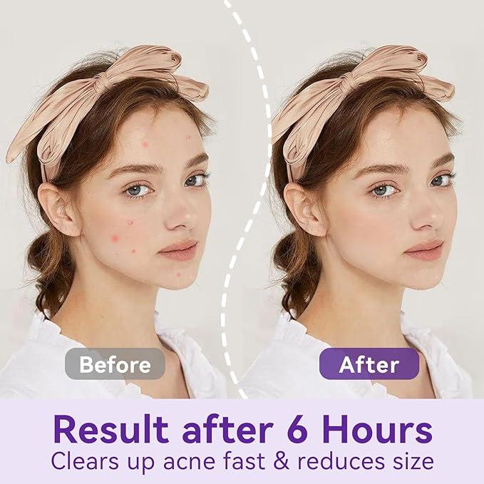 Overnight Pimple Patches for Face - Maximum Strength Hydrocolloid for Cystic Acne & Dark Spots (72 Count) - 10mm & 12mm Medicated Night Time Treatment-BrightBean Baby