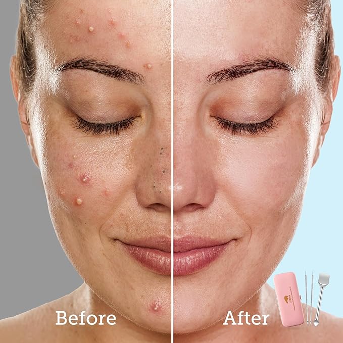 LitBear Pore Prep Tool, Blackhead Remover Pimple Popper Tool Kit, Stainless Steel Blackhead Extractions Tool for Acne, Whitehead Popping, Blemish, Comedone, Pink-BrightBean Baby