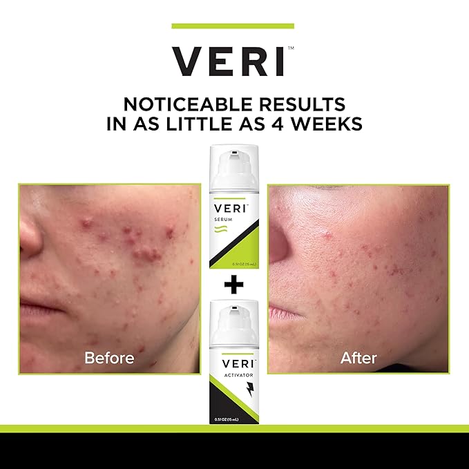 VERI Nitric Oxide + Salicylic Acid Clear Skin System (Peroxide-Free): For Acne Prone Skin, Unclogs Pores, Clarifies Blemishes, Reduces Inflammation, Prevent Future Breakouts, 30 mL / 1 oz-BrightBean Baby