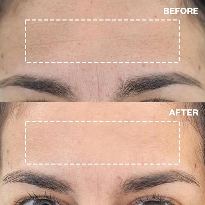 Wrinkles Schminkles Forehead Wrinkle Patches, 4-Pack, Reusable Hypoallergenic Silicone Smoothing Pads for Reducing Frown Lines & Face Lift Overnight-BrightBean Baby