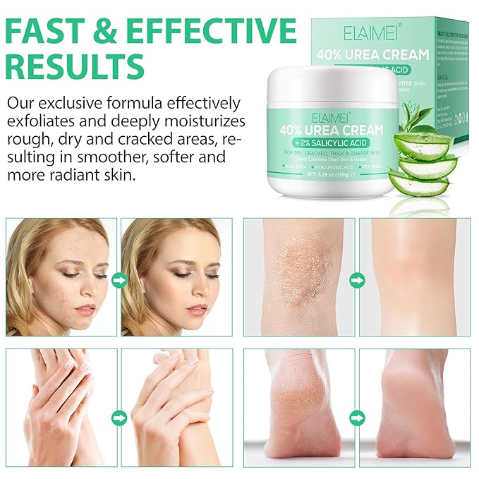 J&H Jasmine&Hyacinth 40% Urea Cream with 2% Salicylic Acid, Aloe, Feet/Heel Cream Moisturizer for Dry Cracked Heel, Knees, Elbows, Hands, Callus Remover, Intensive Hydrating Treatment-5.3 OZ/150 G-BrightBean Baby