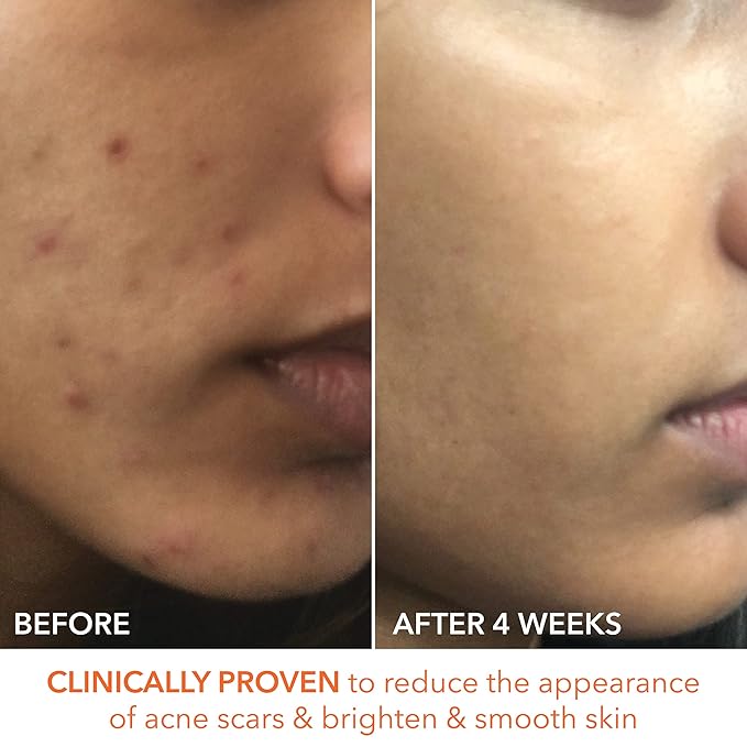 Dr. Dennis Gross Alpha Beta Extra Strength Daily Peel: for Oily Skin, Uneven Tone or Texture, Wrinkles or Enlarged Pores (30 Treatments)-BrightBean Baby