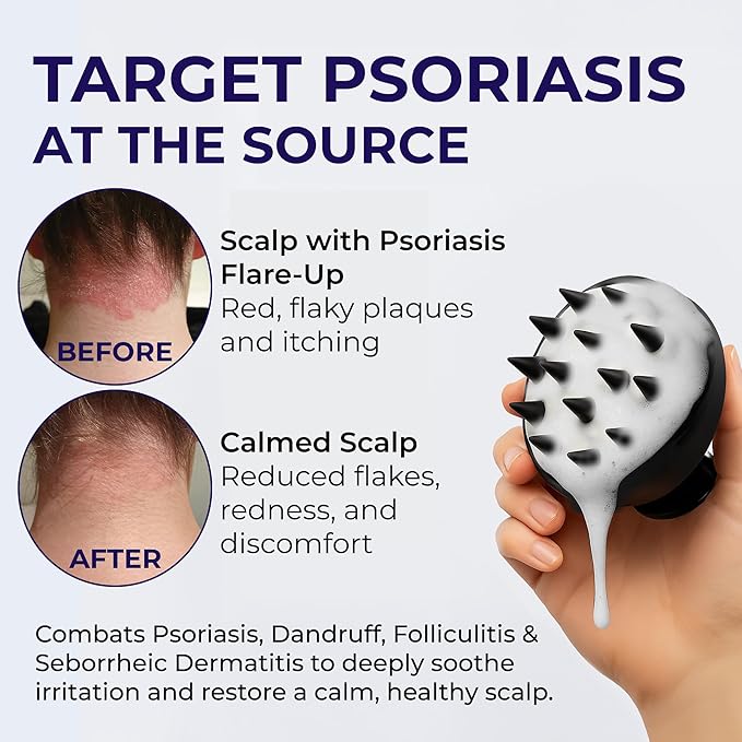 Scalp Psoriasis Shampoo, Flakes Shampoo Anti Dandruff, Itchy Scalp Treatment for Seborrheic Dermatitis & Folliculitis, Anti Fungal, Medicated Solution for Itchy, Flaky & Dry Hairs-BrightBean Baby