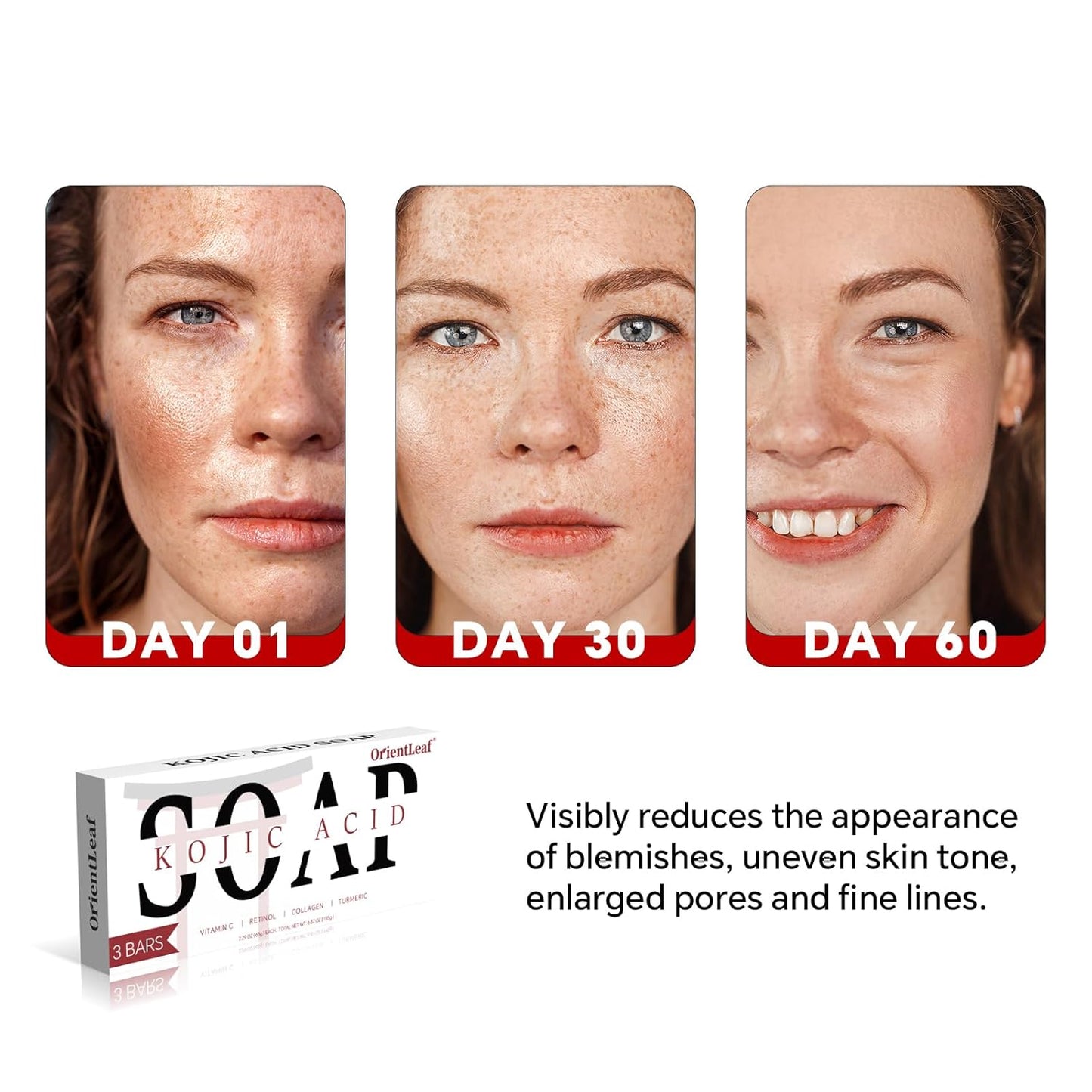 Kojic Acid Soap, Turmeric Soap Bar for Dark Spots, Fresh Citurs Scent, Gentle for Face and Body Wash with Vitamin C, Shea Butter, Retinol, Olive Oil, Collagen (3 PACK)-BrightBean Baby