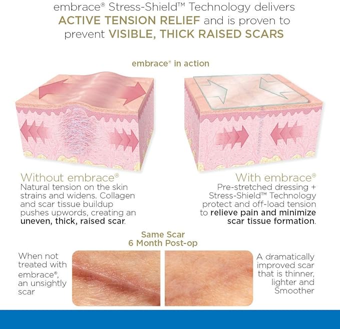 Embrace Active Scar Defense for New Scars, FDA-Cleared Medical-Grade Silicone Scar Sheets for Hypertrophic & Keloid Scar Treatment, 4.7 Inch, Large, 30-Day Supply-BrightBean Baby