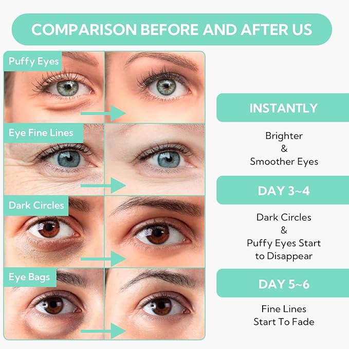 8X Hyaluronic Acid Under Eye Patches(30 Pairs) -Cooling Eye Masks for Deep Moisturizing, with Ectoin Niacinamide Hydra-Gel Collagen, Puffy Eyes Treatment, Fine Lines & Wrinkles Reduce-BrightBean Baby