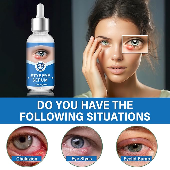 Stye Eye Treatment, Stye Eye Serum for Styes Chalazion and Blepharitis, Gently Cleanses Lashes and Eyes, Restore Healthier Eye Skin, 1 Fl.oz-BrightBean Baby