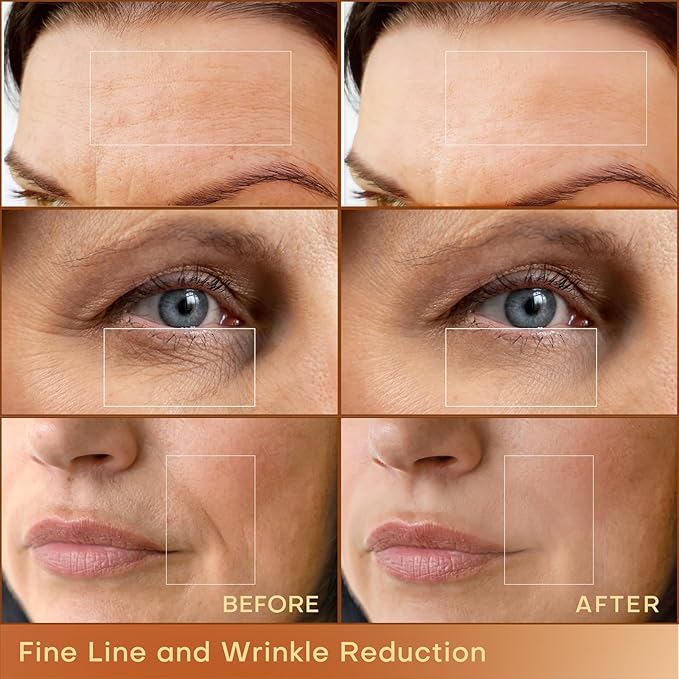 MLAY Professional RF Beauty Machine, Radio Frequency Face Machine with 2 Probes, at Home Radio Frequency Skin Tightening for Lifting, Wrinkle Reducing, Anti Aging - Salon Effects（Gel Included）-BrightBean Baby