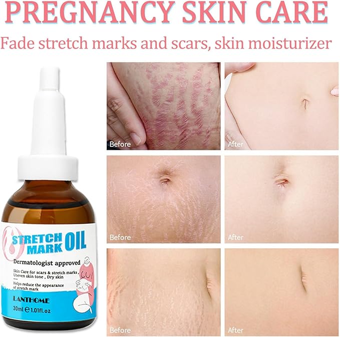Stretch Mark Pregnancy Massage Oil, Stretch Mark Oil, Skincare Oil for Improve Stretchmarks, Pregnancy Skin Care Fade Stretch Marks, Body Moisturizer for Dry Skin, First Time Mom Gift 30 ml-BrightBean Baby