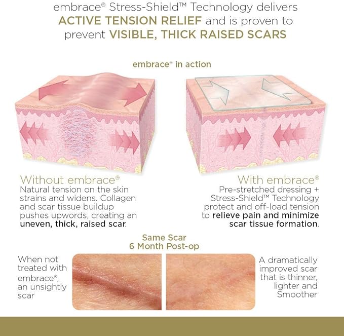 Embrace Active Scar Defense for New Scars, FDA-Cleared Medical-Grade Silicone Scar Sheets for Hypertrophic & Keloid Scar Treatment, 6.3 Inch, Extra-Large, 30-Day Supply-BrightBean Baby